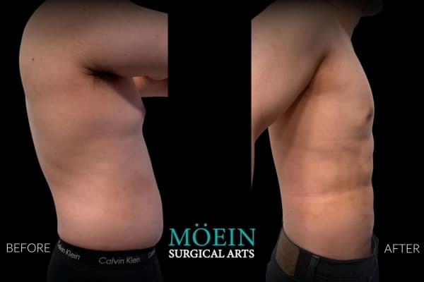 Best ab etching and gynecomastia before and after Beverly Hills