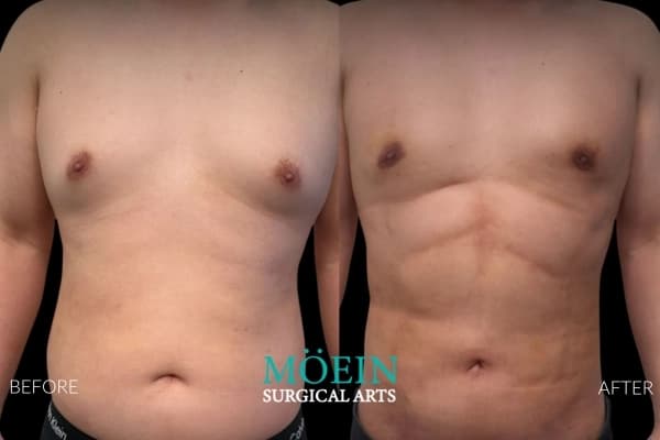 Ab etching and gynecomastia results Beverly Hills