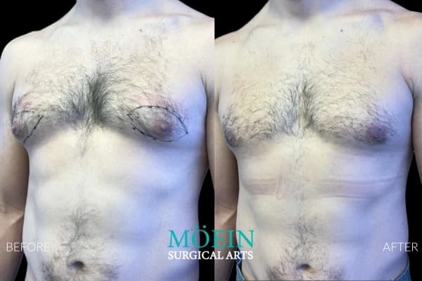 Gynecomastia surgery before and after Los Angeles — patient 10