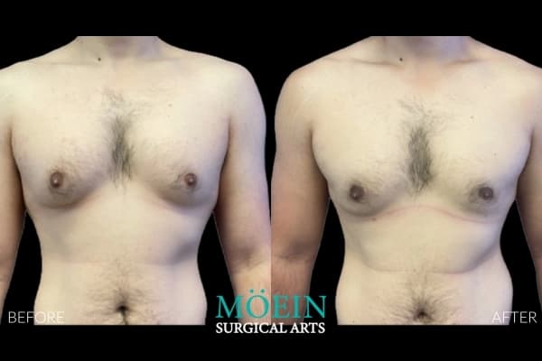 Gynecomastia surgery before and after Los Angeles — patient 11