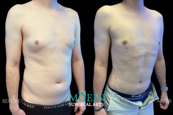 Gynecomastia surgery before and after Los Angeles — patient 3