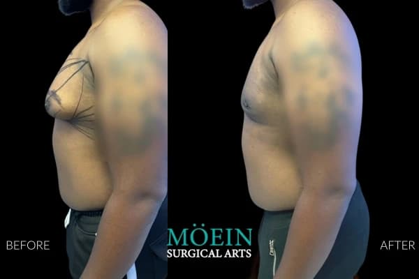 Gynecomastia surgery before and after Los Angeles — patient 4
