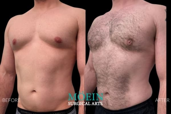 Gynecomastia surgery before and after Los Angeles — patient 5