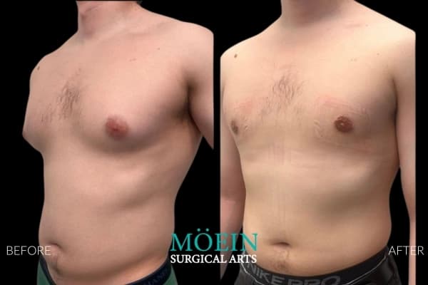 Gynecomastia surgery before and after Los Angeles — patient 6