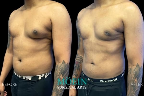 Gynecomastia surgery before and after Los Angeles — patient 7
