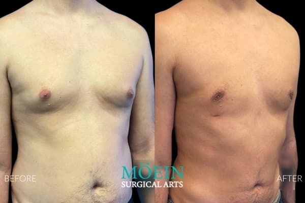 Gynecomastia surgery before and after Los Angeles — patient 9