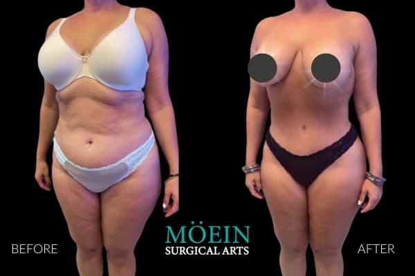 VASER liposuction before and after Los Angeles — patient 3